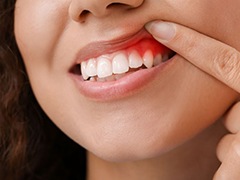 Woman lifting her lip, showing infected gums