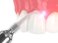 Illustration of dental laser being used on gum tissue