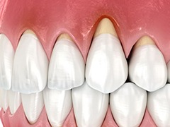 Illustration showing receding gums on front teeth