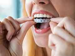 A woman placing Invisalign aligners over her teeth