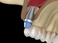 Illustration of dental implant in jawbone after sinus lift