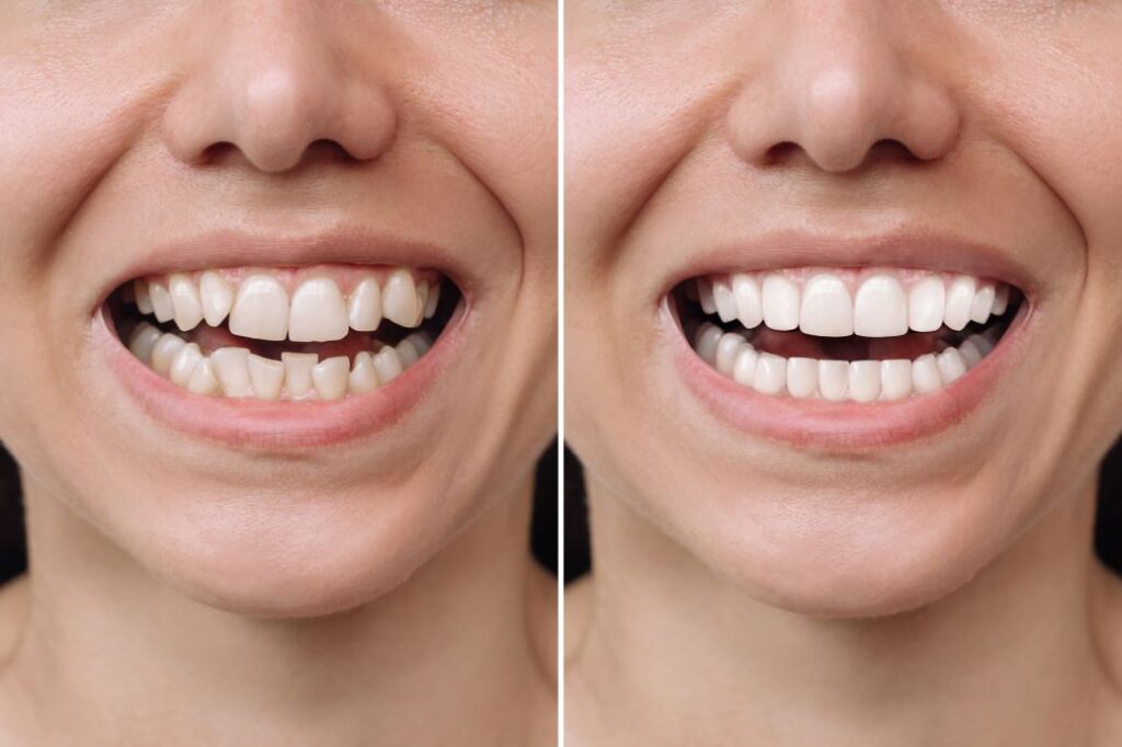 A before and after image of a woman with veneers